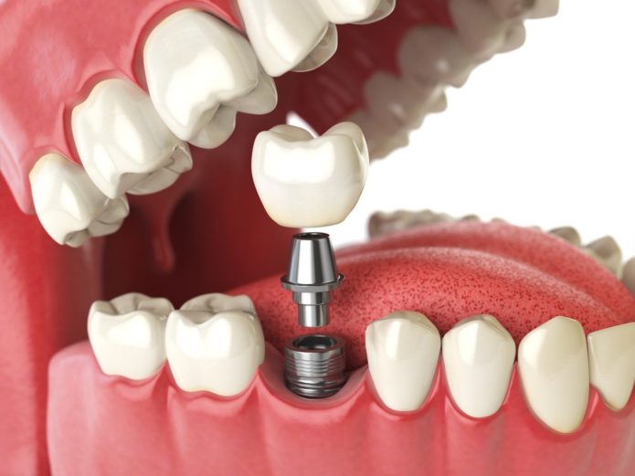 Instalación de implantes