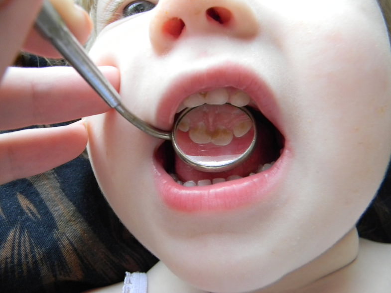 Descripción de las causas de caries en niños.