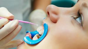 Características del plateado de los dientes de leche en niños.