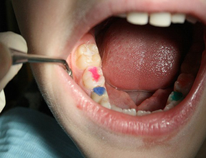 Ventajas y desventajas del plateado y pulido dental para niños.