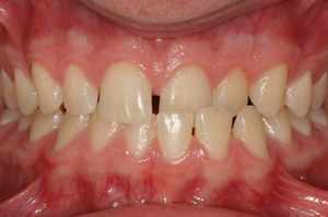 Causas e indicaciones para la derivación a un médico ortodoncista-dentista