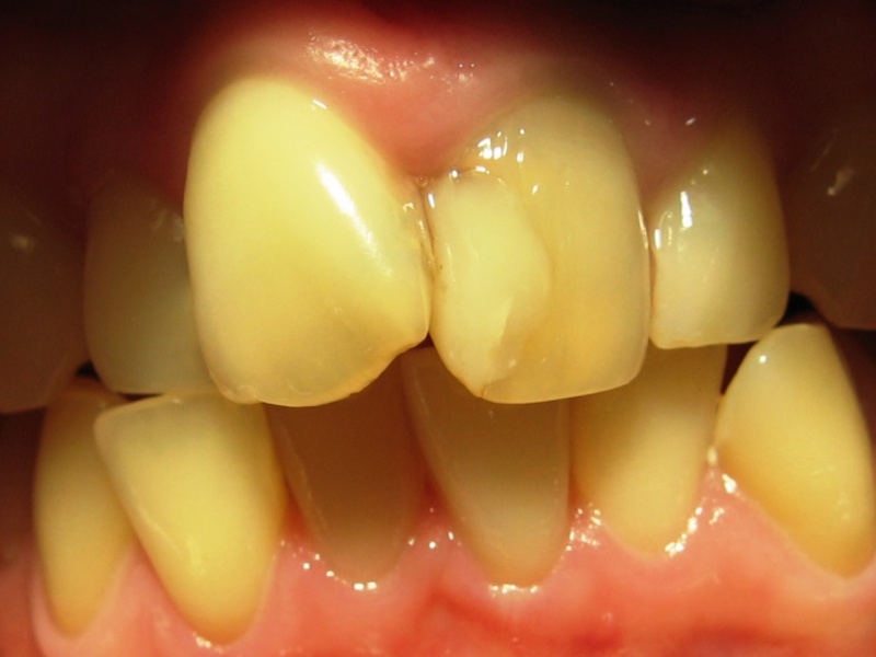 Cómo instalar carillas en los dientes.