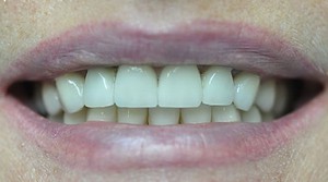 Coronas dentales de cerámica en los dientes - indistinguibles de los dientes reales