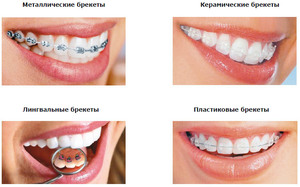 ¿Cómo es la prótesis dental?
