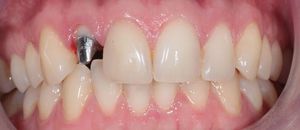 Coronas de circonia - otra versión de material dental.