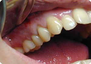 Encías inflamadas alrededor del diente