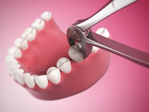 Kogad necesita quitar ocho dientes inferiores.