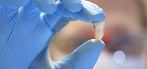 Consecuencias después de la extracción dental.