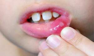 ¿Por qué se desarrolla la estomatitis?