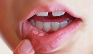 Métodos tradicionales de tratamiento de la estomatitis.