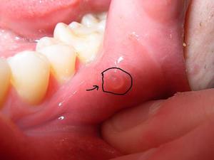 Tratamiento de la estomatitis