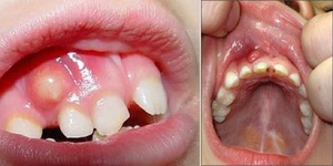 Descripción de los tipos de periostitis.