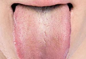 Cómo tratar la placa en la lengua.