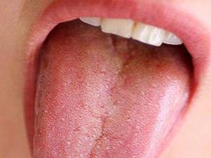 Pátina amarilla en la lengua