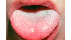 ¿Qué enfermedades se pueden determinar por el color de la lengua?