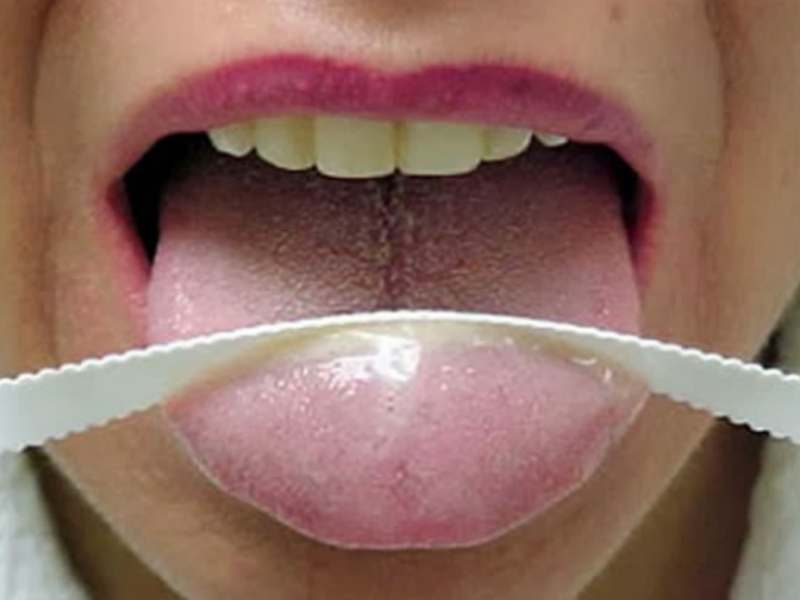 Como remover la placa de la lengua. Cómo deshacerse de la placa en el idioma.