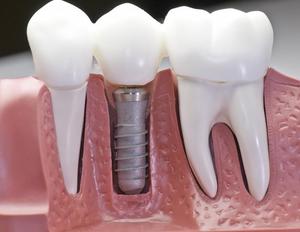 Contraindicaciones para la instalación de implantes.