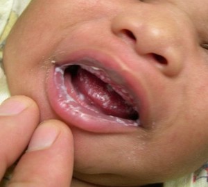 Etapa de la enfermedad de la candidiasis
