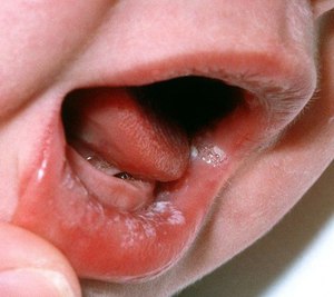 Cómo tratar la candidiasis