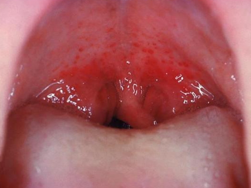 ¿Qué fármacos para tratar el edema laríngeo?