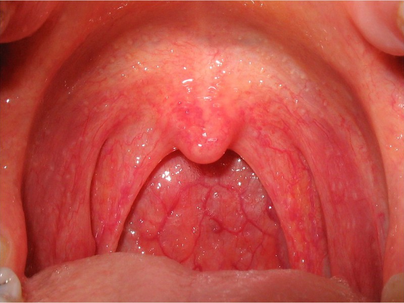 ¿Cuáles son los síntomas del edema laríngeo?