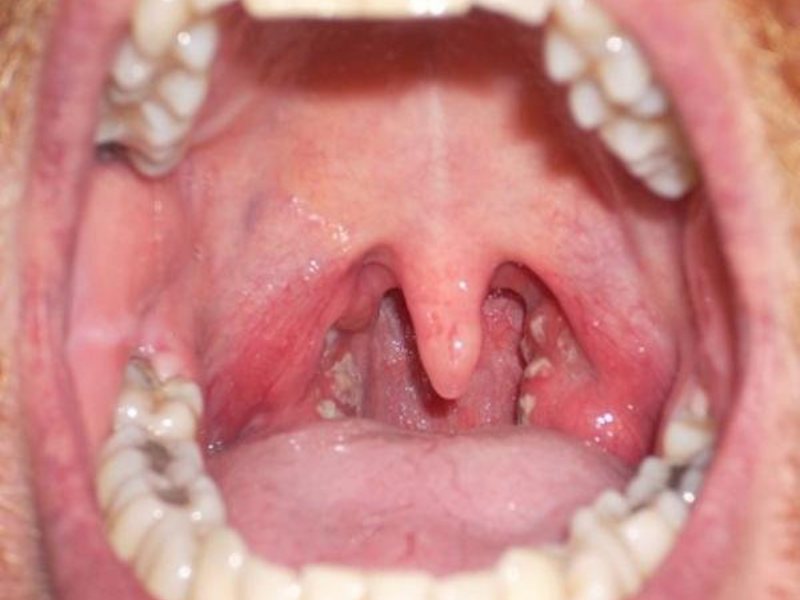 Medicamentos para el tratamiento del edema laríngeo.
