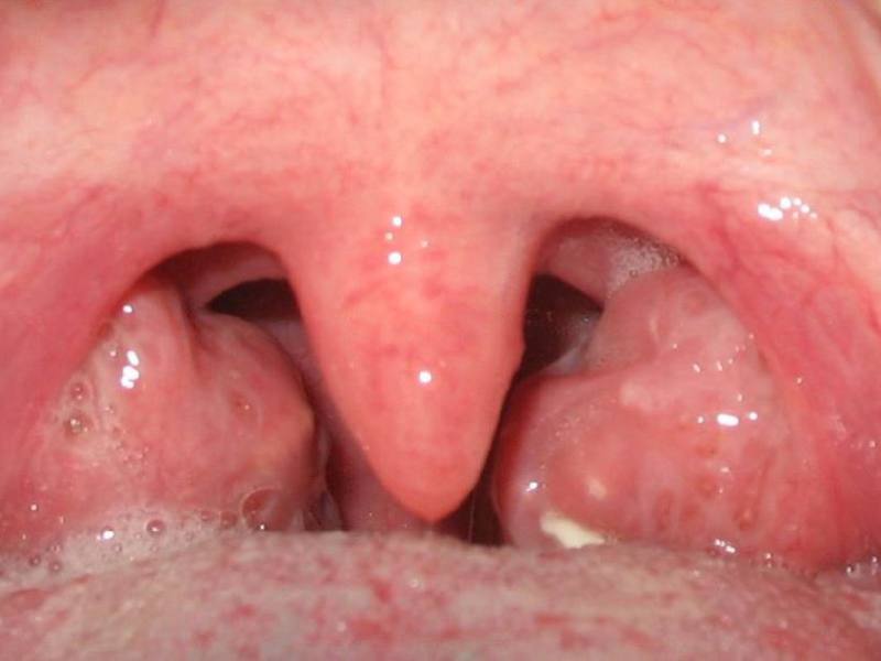 Tratamiento del edema laríngeo en el hospital.