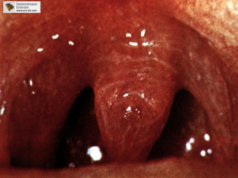 Tratamiento del edema laríngeo en domicilio.