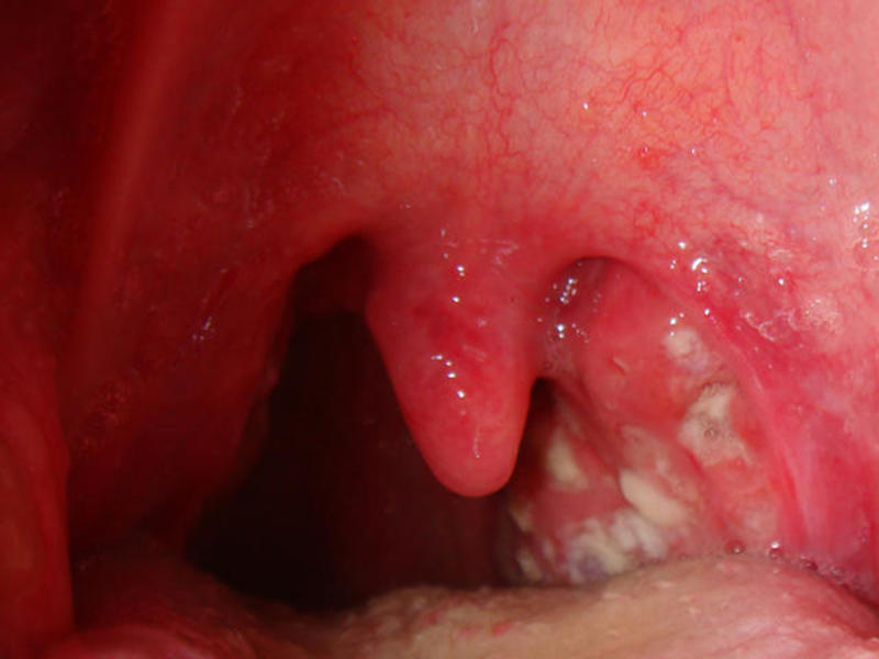 Causas del edema laríngeo.