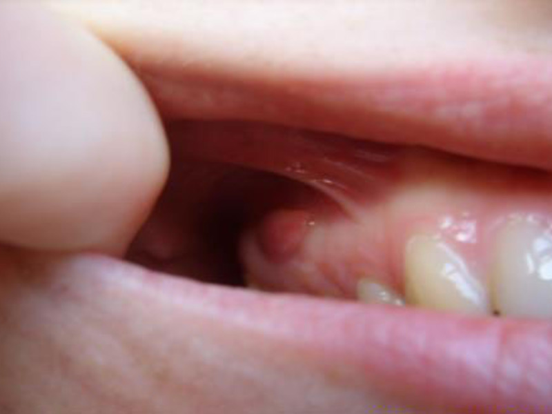 Malestar en la boca del quiste. Dolor de quiste dental