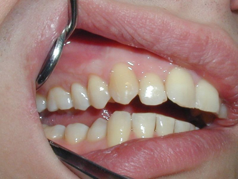 ¿Qué aspecto tiene un quiste dental? Cómo eliminar un quiste