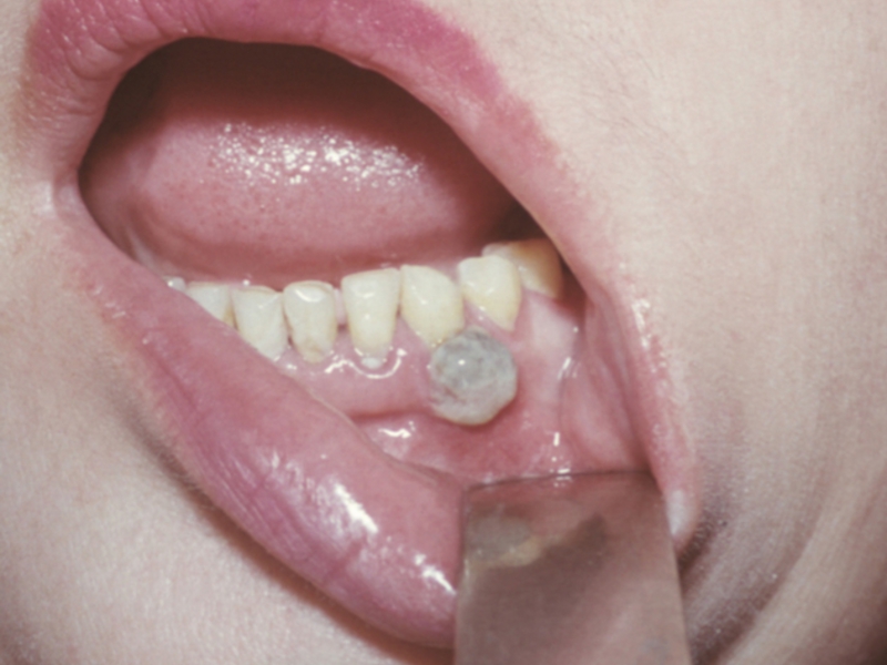 Dolor de dientes Malestar por los quistes del diente.