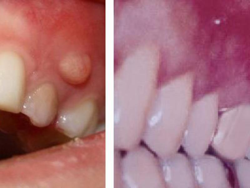 Quiste en la raíz del diente Cómo tratar un quiste dental