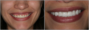 Fotos de carillas en los dientes. Carillas montadas en los dientes.