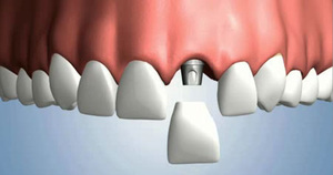 Implante dental