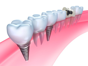 Implante laser de dientes. ¿Qué son los miniimplantes?
