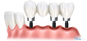 Contraindicaciones para la implantación.
