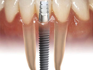 La historia de los implantes dentales. Descripción de los principales tipos de implantes dentales.