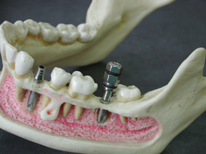 Implantacion de dientes Proceso de implantación dental.