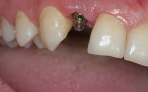 ¿Cómo es la implantación láser de los dientes?