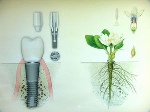 Tipos de implantes dentales