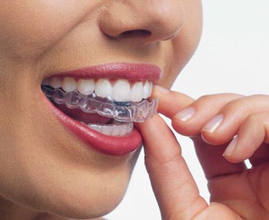 El precio de las dentaduras de silicona.