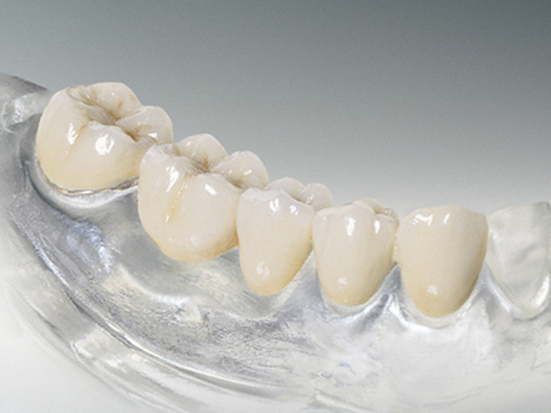 Beneficios de las dentaduras de silicona