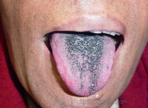 Toque de lengua negra