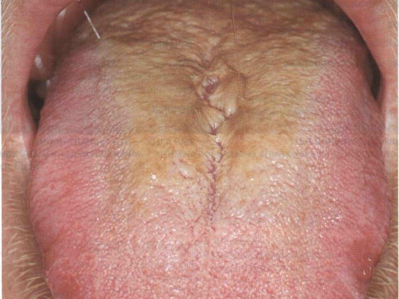 Causas de la lengua amarilla.