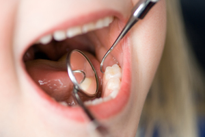 Etapa de dientes plateados.
