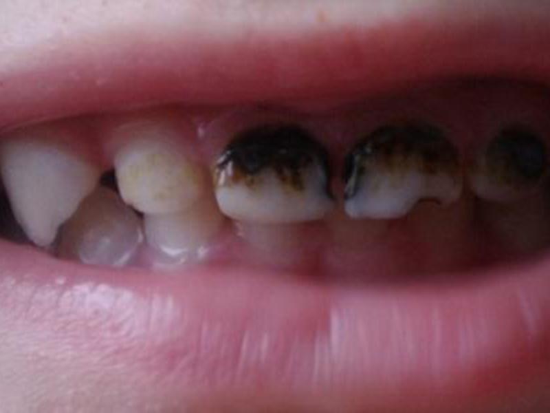 Tratamiento de dientes de leche.