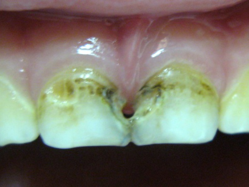 Enfermedad dental de los dientes