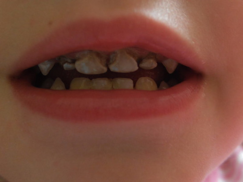 Restauracion de dientes
