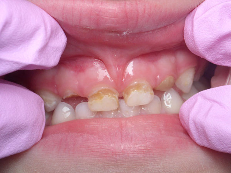 Los dientes de leche en los niños sus problemas.